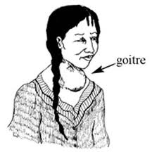 goitre